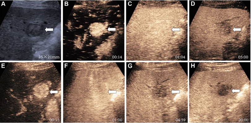 Ultrasound shows images of a 66 year old male at risk for HCC due to hepatitis B virus infection and liver cirrhosis